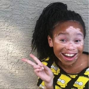 ¡Una gran sonrisa vitiligo!