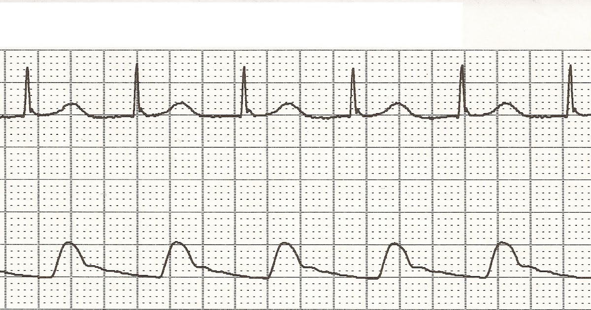 Float Nurse EKG Rhythm Strips 28 Junctional Rhythms