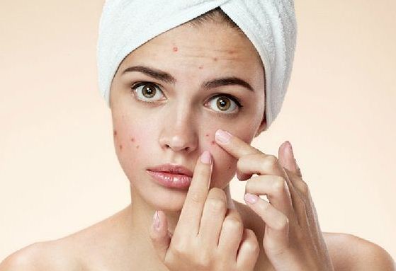 How to Get Rid of Pimples With Baking Soda?