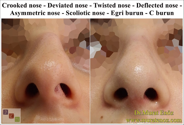 Eğri burun nedenleri - Eğri burun tanımı - Eğri burun estetiği - Eğri burun ameliyatı - Eğri burun tedavisindeki zorluklar - Crooked nose - Deviated nose - Twisted nose - Deflected nose - Asymmetric nose - Scoliotic nose - Eğri burun - C burun