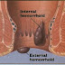 benjolan di anal wasir hemoroid parah