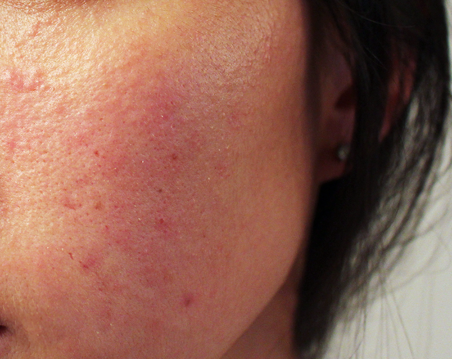 Allergic Reaction To Makeup Rash - Mugeek Vidalondon Makeup Allergic Reaction