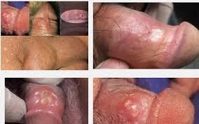 apa penyebab lecet diujung penis apa penyebab lecet diujung penis