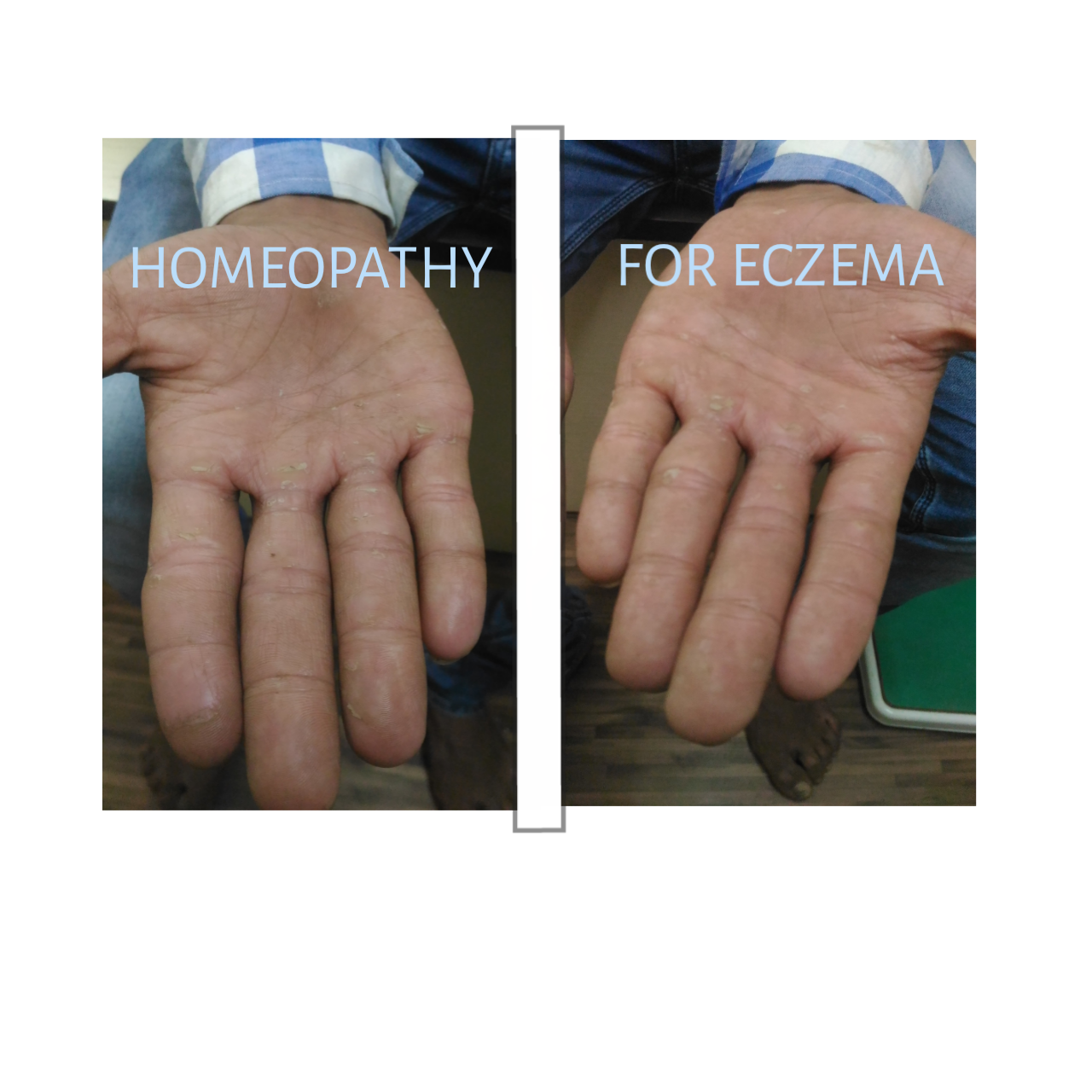 ECZEMA AND ITS HOMEOPATHY REMEDY ALL ABOUT HOMEOPATHY