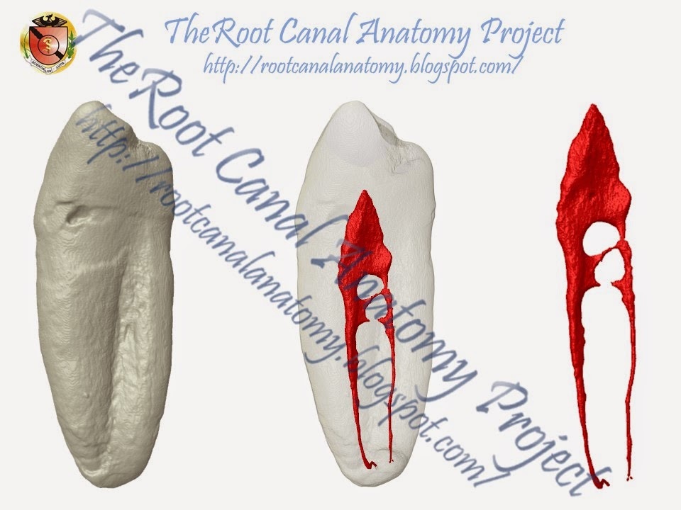 The Root Canal Anatomy Project: Mandibular First Premolar: Two Root Canals