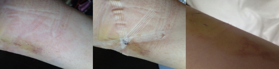 an image of contraceptive implant bruising 