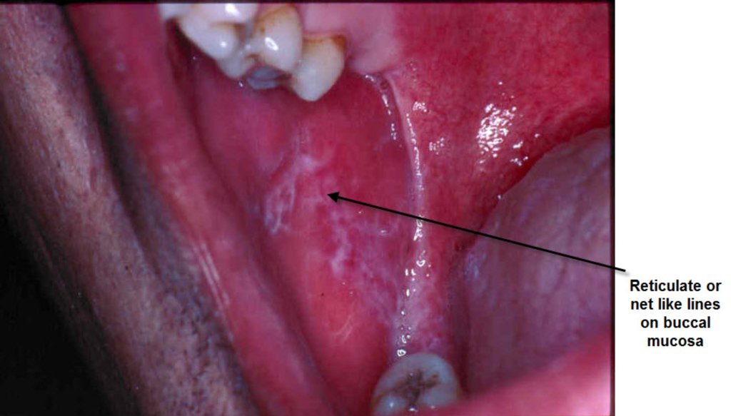 Mouth Conditions › Lichen planus - Oral Health Foundation