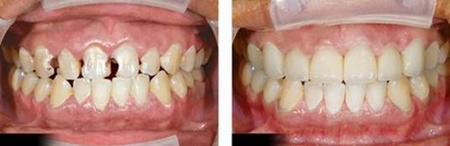 LÀM RĂNG SỨ HAI CÁI RĂNG CỬA LÀ BAO NHIÊU TIỀN -3