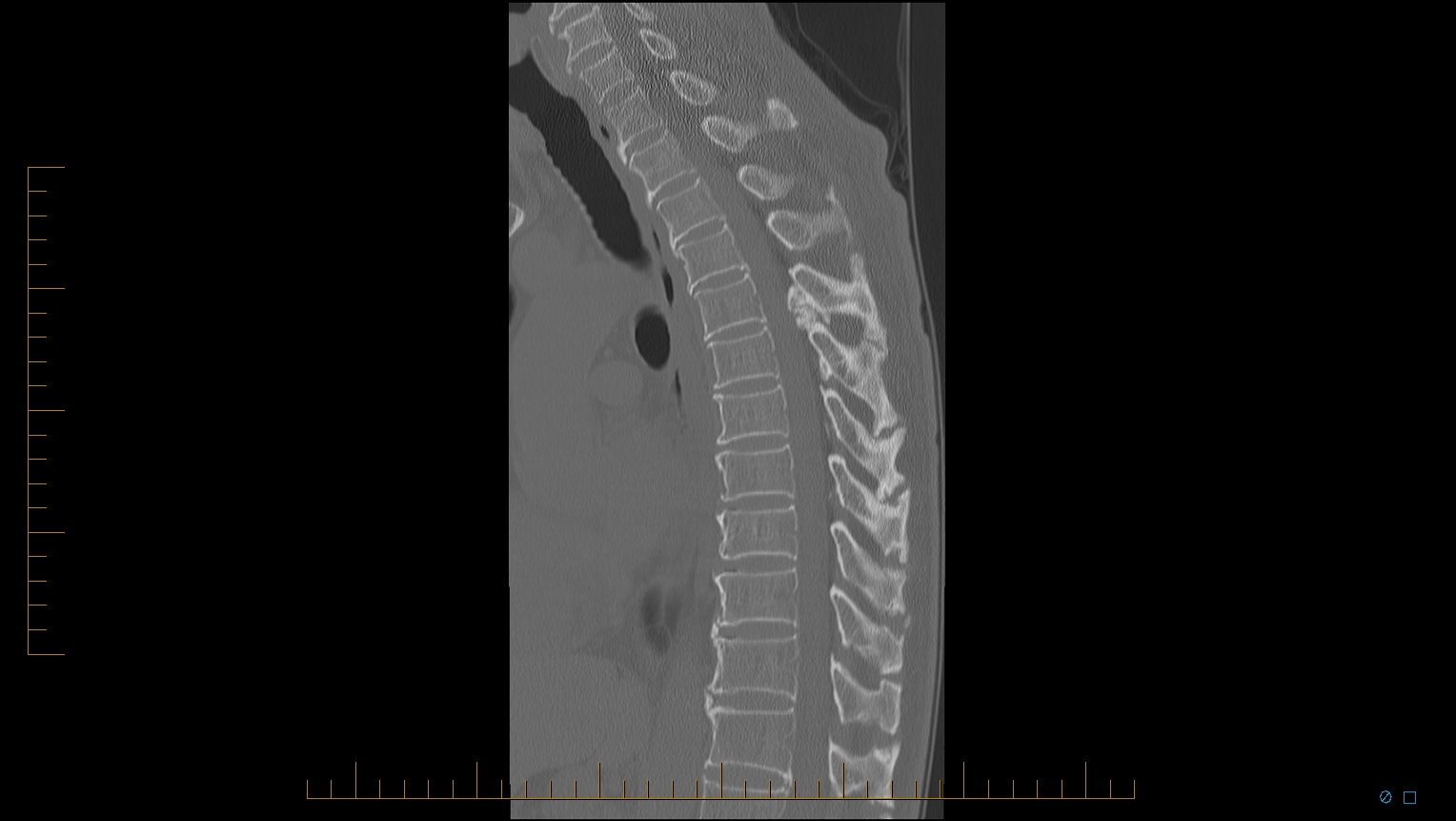 торакалгия грудного отдела позвоночника симптомы
