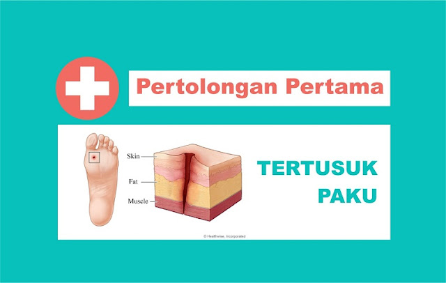 Tertusuk Paku 7 Langkah Praktis Pertolongan Pertama Tertusuk Paku agar Terhindar dari Tetanus