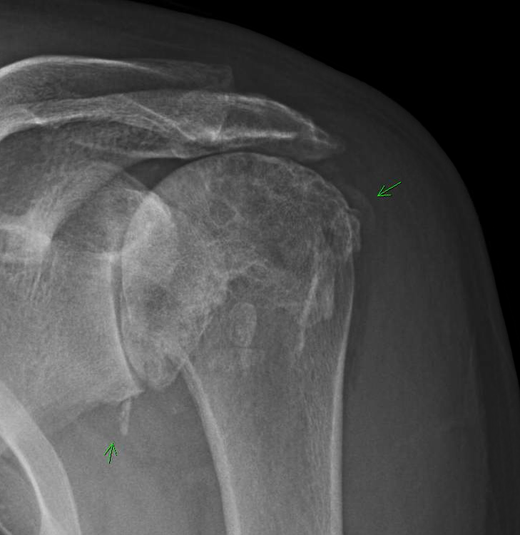 UW Shoulder and Elbow Academy Shoulder arthritis and complete cuff deficiency the CTA prosthesis