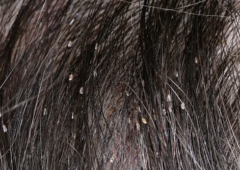 Hair with lice infestation