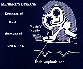 Health Care: Meniere’s Disease