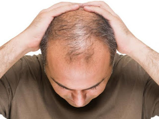 Calvicie, afecta a más del 50% de los hombres sobre los 50 años, es hereditaria y se produce por una hipersensibilidad del pelo a las hormonas derivadas de la testosterona