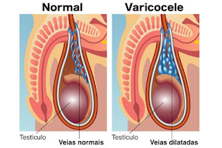 Obat Varikokel Alami