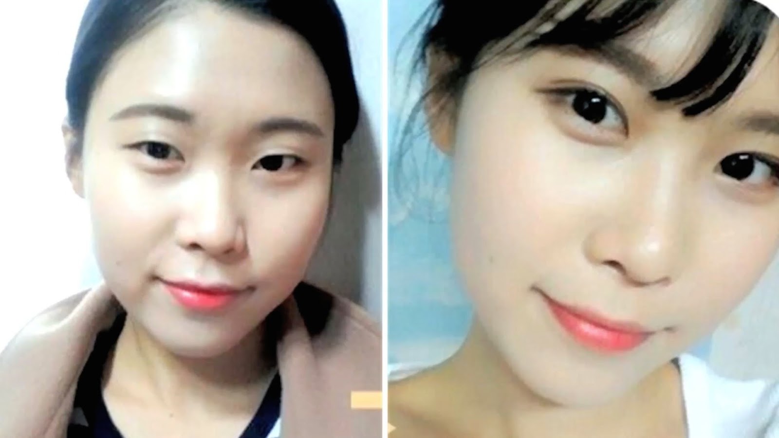Double eyelid surgery (adding a crease in the eyelid) .