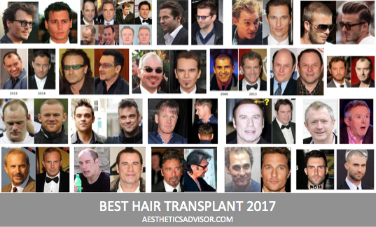Best hair transplant Singapore