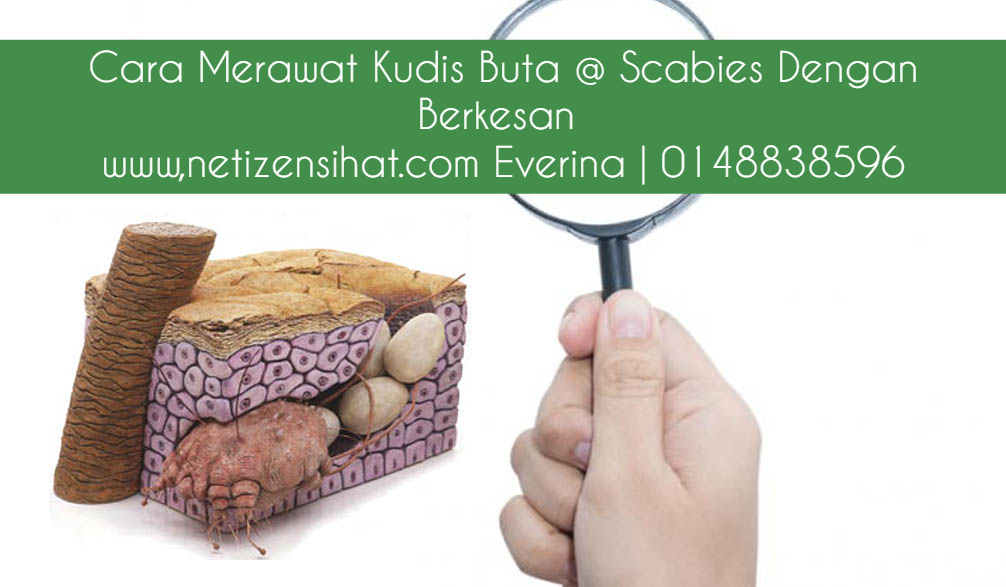 Cara Merawat Kudis Buta Scabies Dengan Berkesan Netizen Sihat