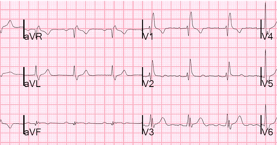 Блог по клинической электрофизиологии Блокада правой