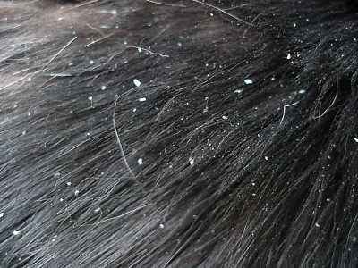 Mzansifro Fix It Friday How To Avoid White Flakes On Your Hair