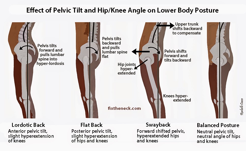 Poor Postural Analytic ARTIKEL FISIOTERAPI poor-postural-analytic-artikel-fisioterapi