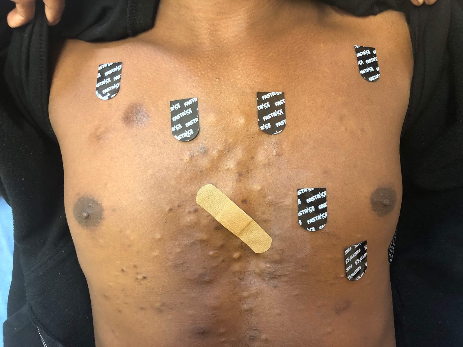 Dr. Smith's ECG Blog Chest pain and Twave inversion in lead V2