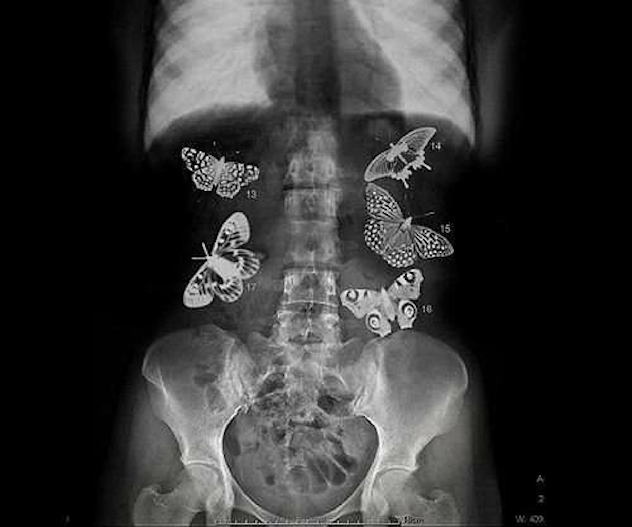 Бабочки в легких рентген