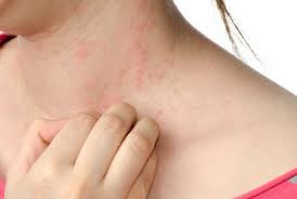 Top 10 Natural Remedies For Hives