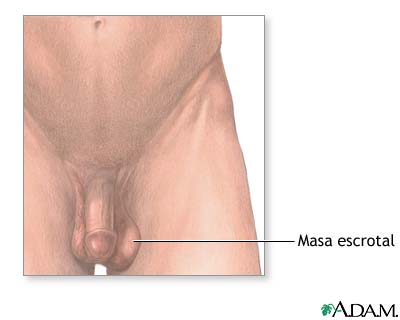 tengo un bulto al lado del testiculo izquierdo