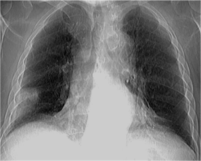 Quiz chest X-ray-chest pain-emergency medicine book