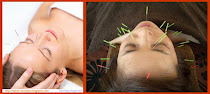 Acupuntura facial estética