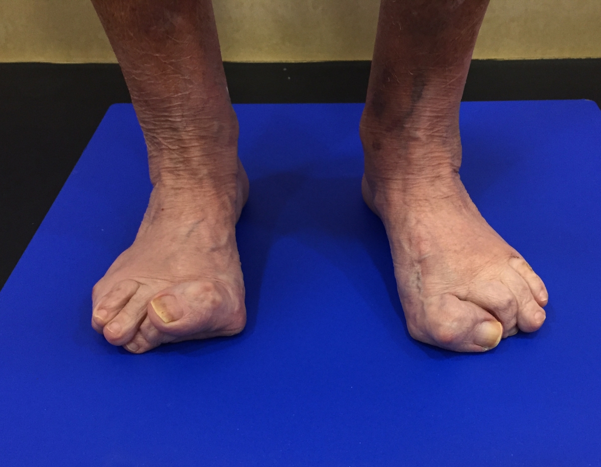 SIULMARehabilitación : #PIE #INESTABLE