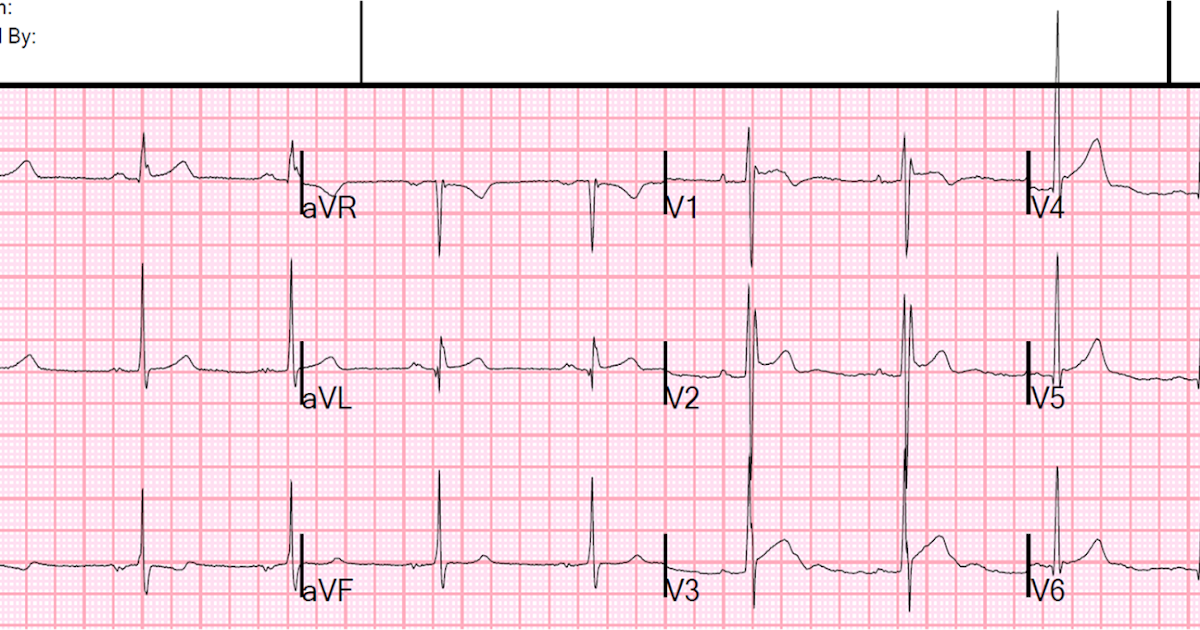 Dr Smith's ECG Blog Is This Type 60 Brugada SyndromeECG Pattern Delectable Ecg Pattern Dr Smith's ECG Blog Is This Type 60 Brugada SyndromeECG Pattern Delectable Ecg Pattern