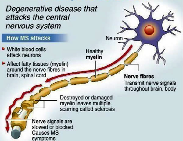 About Health: Multiple Sclerosis About Health: Multiple Sclerosis