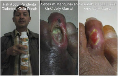 Cara Menyembuhkan Luka Borok di Kaki Secara Alami Sampai Tuntas ~ Testimoni QNC JELLY GAMAT Cara Menyembuhkan Luka Borok di Kaki Secara Alami Sampai Tuntas ~ Testimoni QNC JELLY GAMAT