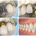 Trồng răng implant chi phí là bao nhiêu tiền ?