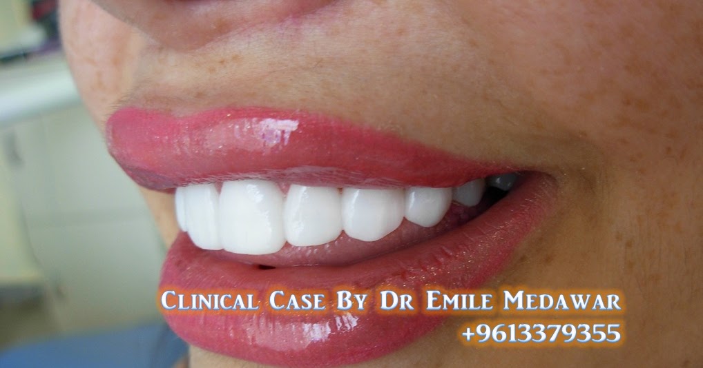 Dental Implants Surgeon in Lebanon, Dr Emile Medawar, 00 961 3 379355