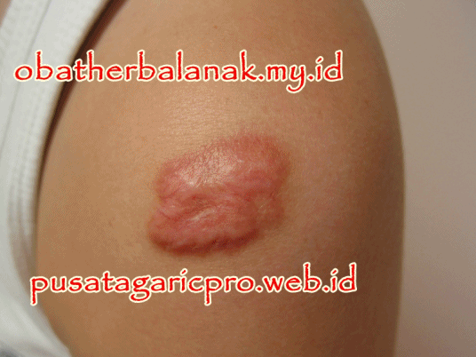 Pengobatan Keloid Paling Ampuh dan Tradisional Pengobatan Keloid Paling Ampuh dan Tradisional