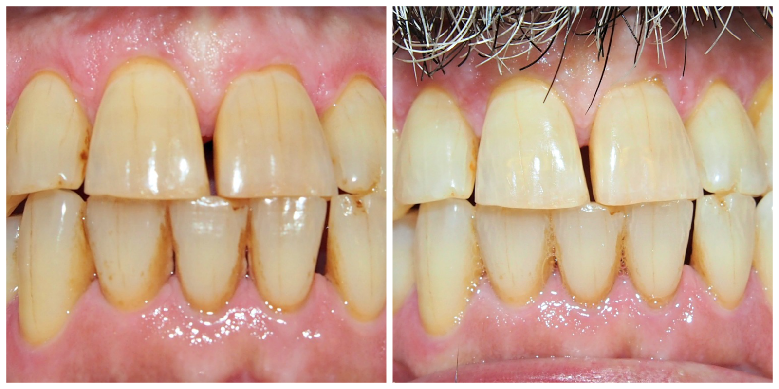 The Secret to Whitening your Teeth... TOOTH GERM