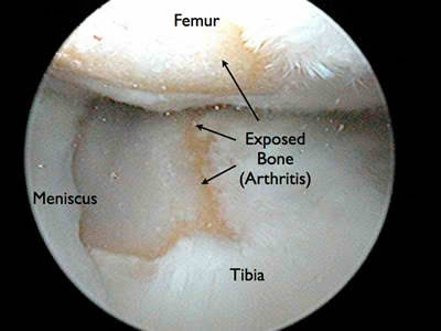 total hip replacement doctor best othopedic surgeon in paranaque