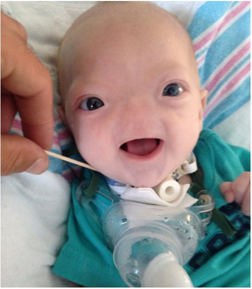 Baby Born Without Nose Is Very Cute Pictures Going Viral - Style Hunt World
