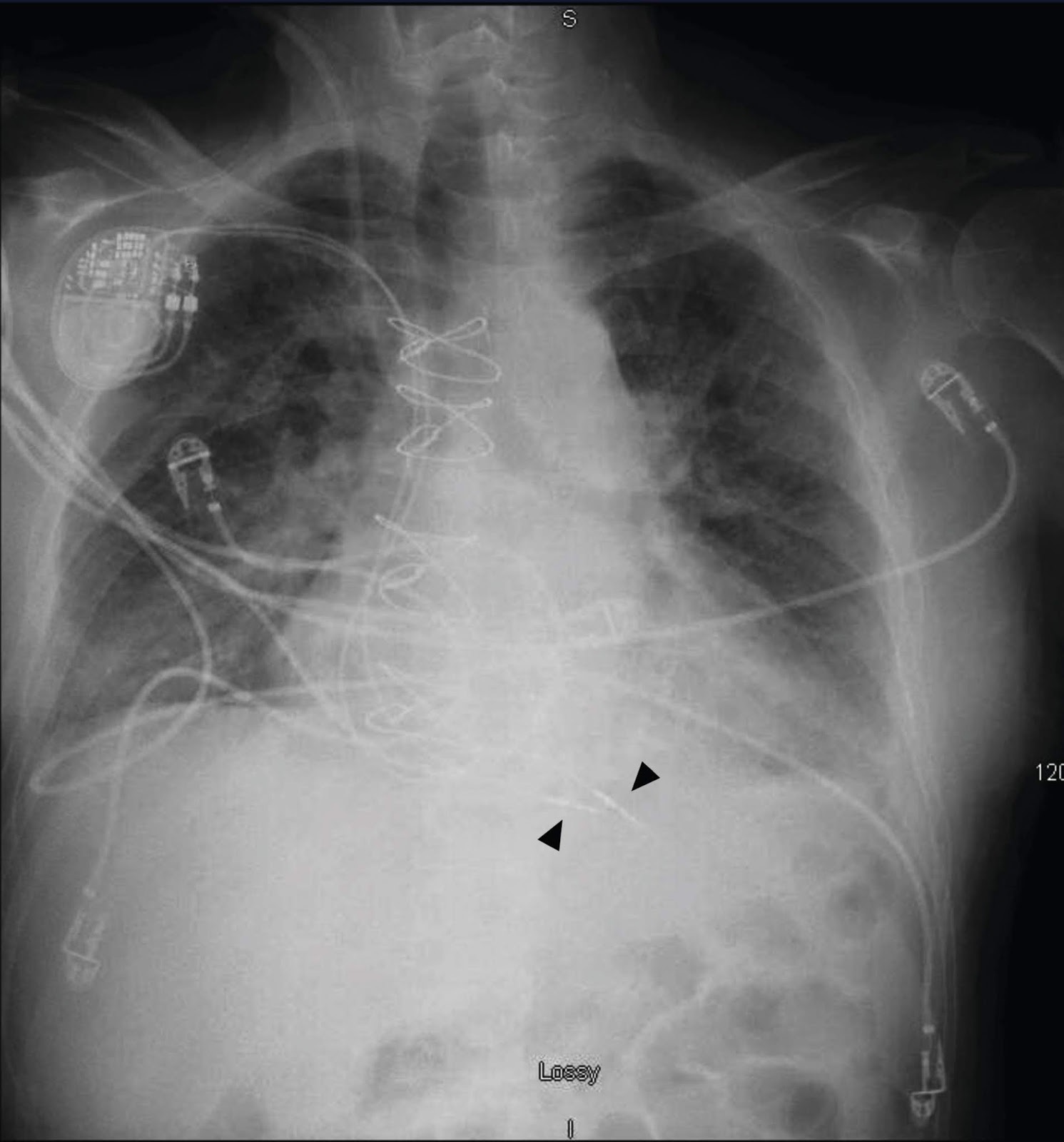 Focus on ECGs Case 15 — Chest Radiograph Clarifies an