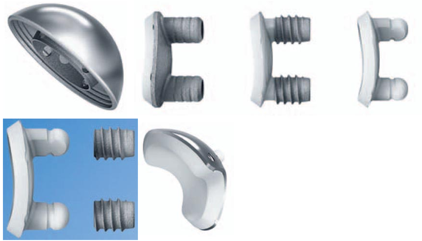 Shoulder and Elbow Surgery: Identifying the implanted shoulder ...