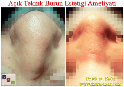 Açık Teknik Burun Estetiği Ameliyatı - Açık Rinoplasti Açık Teknik Burun Estetiği Ameliyatı - Açık Rinoplasti