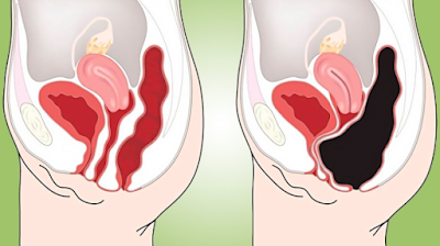 How To Remove 30 Pounds Of Waste From Your Colon