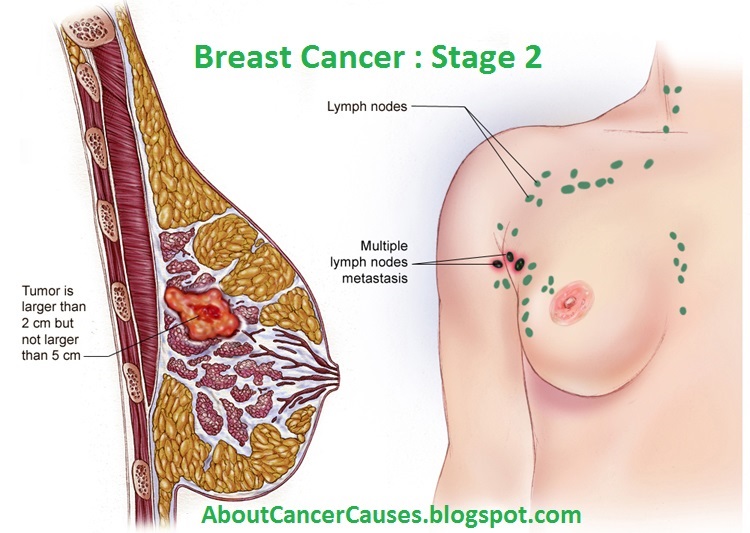 Breast Cancer : Stage 2 Breast Cancer : Stage 2