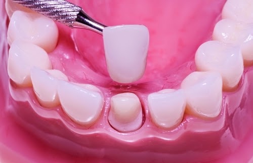 Restauration dentaire