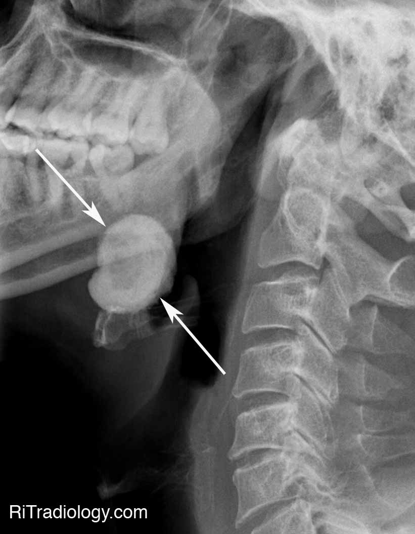 RiT radiology Sialolithiasis