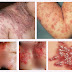 Cara Menjaga Kesehatan Supaya Terhindar Dari Penyakit Herpes