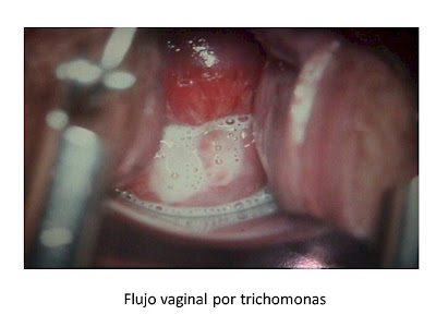 Flujo vaginal por trichomonas